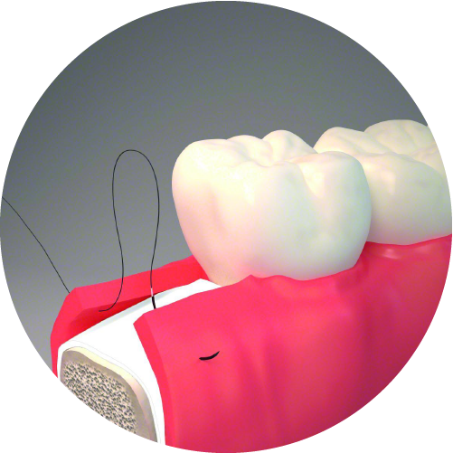 ROW > Dental > SUTURES ORAL RESORBA®